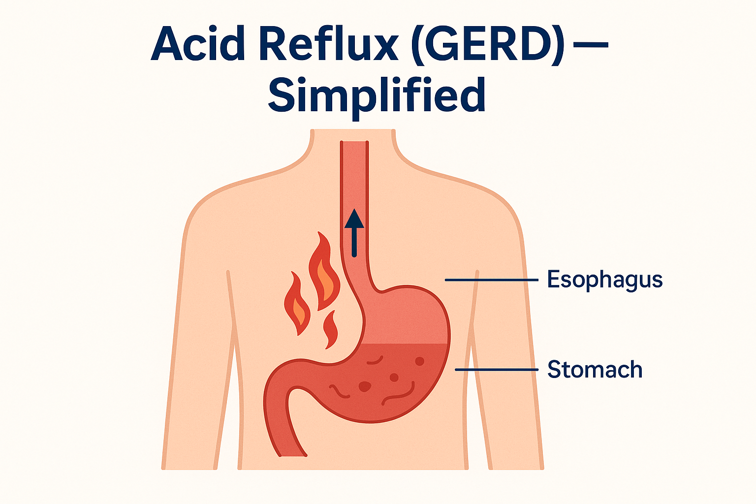 Acid Reflux (GERD) — Simplified for Patients